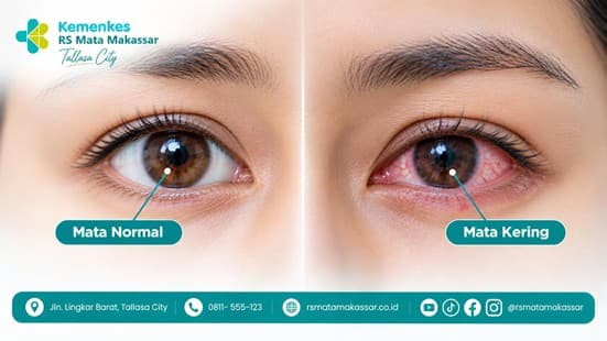 Sering Merasa Mata Kering? Bisa Jadi Anda Mengalami Dry Eye
